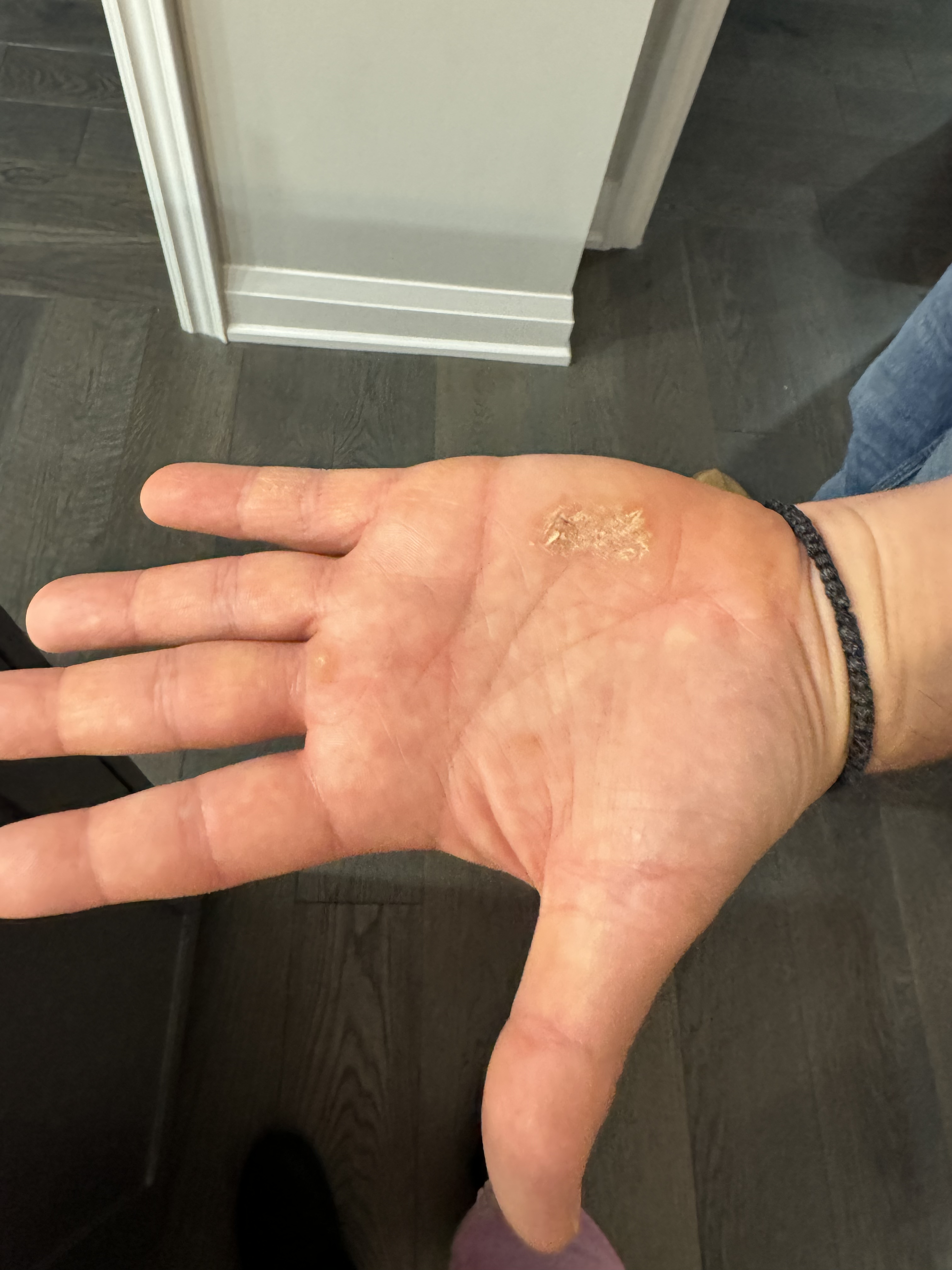 Fissured scaly plaques on palms