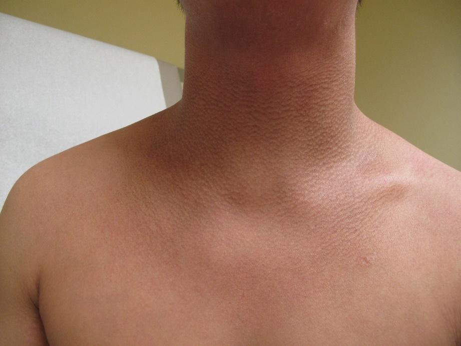 Mild dermatitis with lichenification and hyperpigmentation on neck