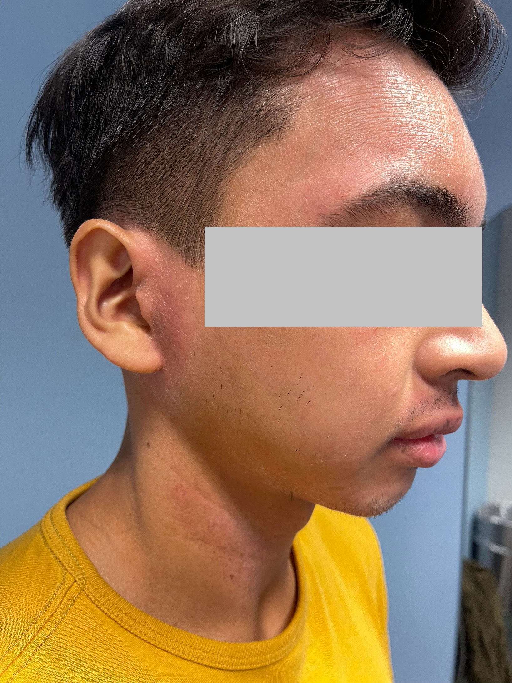 Ongoing facial eczema