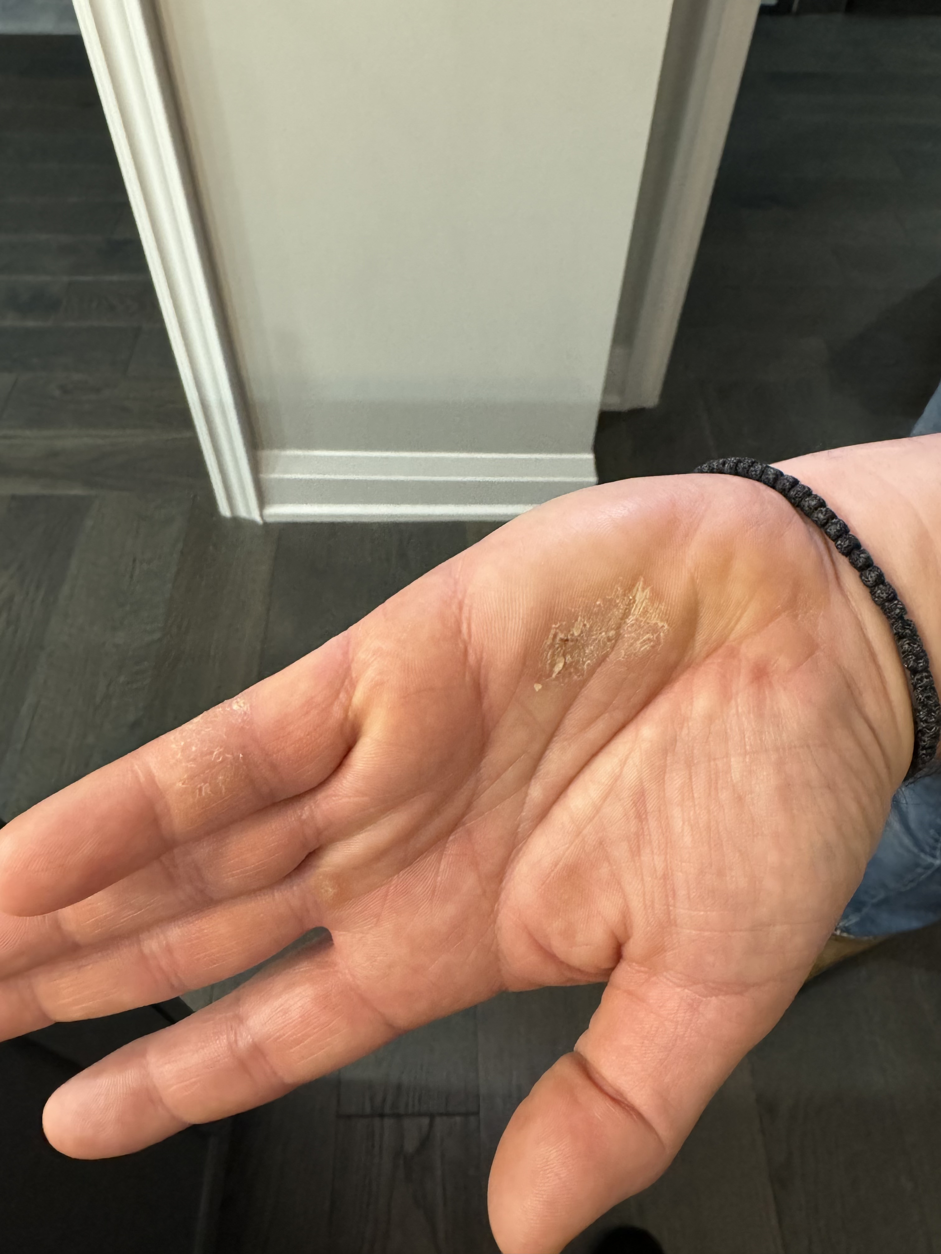 Fissured scaly plaques on palms and lateral fingers