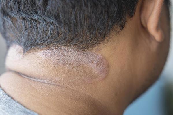 Neck plaques with red-purple hue, thickness and scale