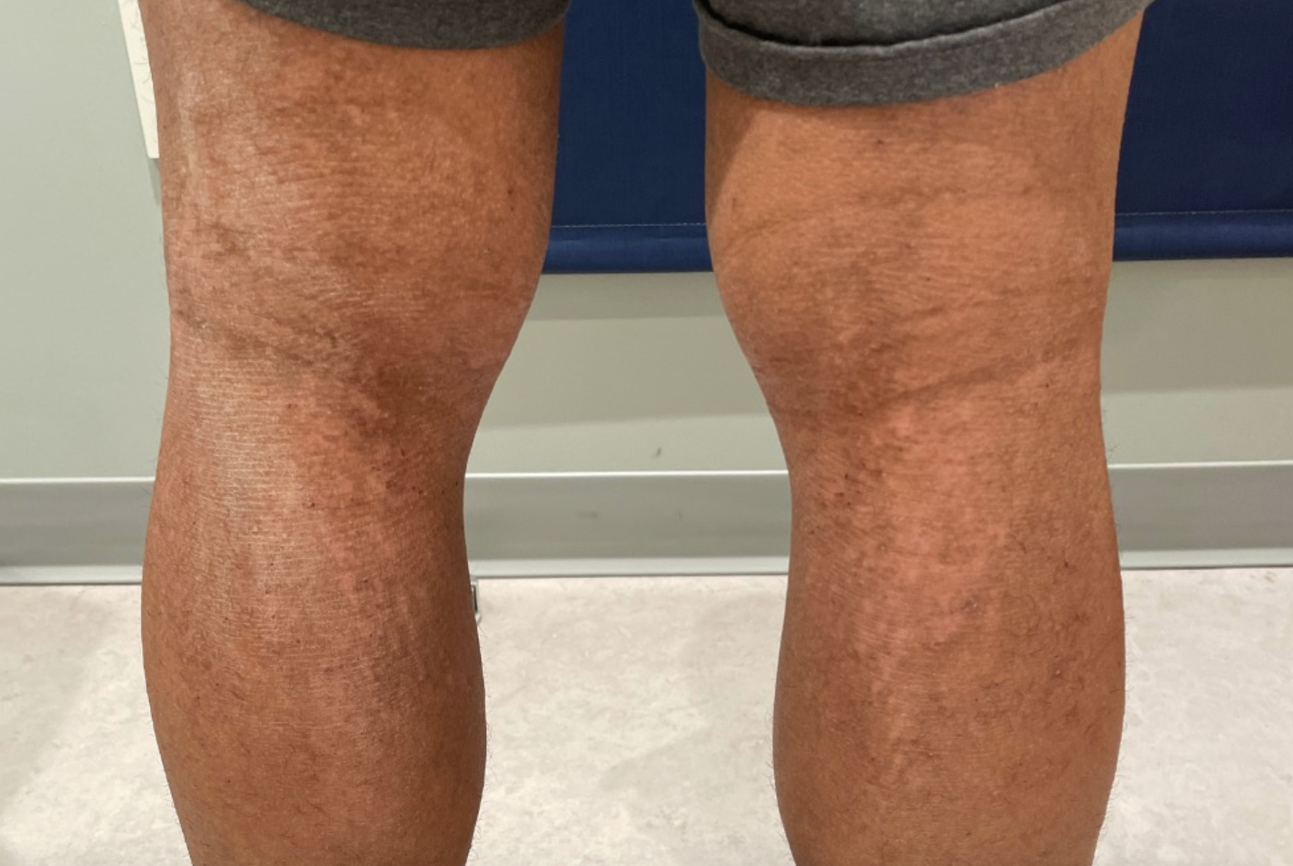 popliteal fossa