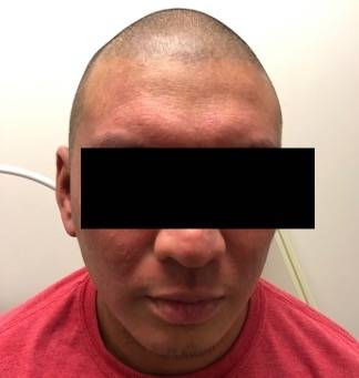 Facial erythema with no scaling.
No previous facial involvement of AD